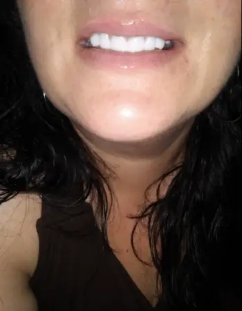 Instant Smile Veneer (Upper & Lower) photo review