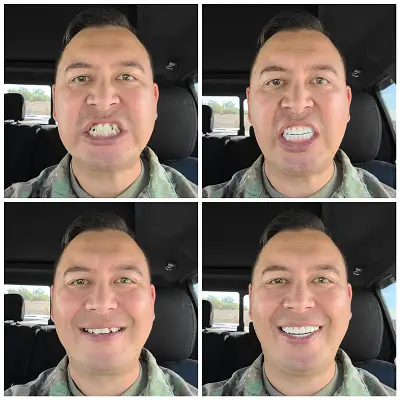 Instant Smile Veneer (Upper & Lower) photo review