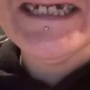 Instant Smile Veneer (Upper & Lower) photo review