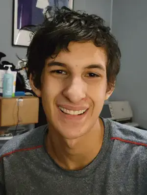 Instant Smile Veneer (Lower Only) photo review