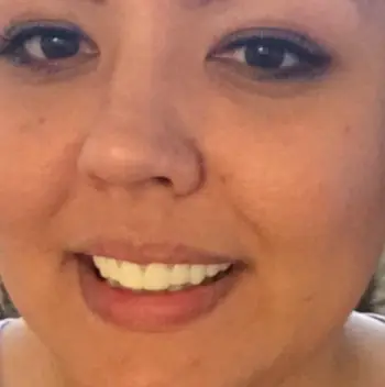 Instant Smile Veneer (Lower Only) photo review