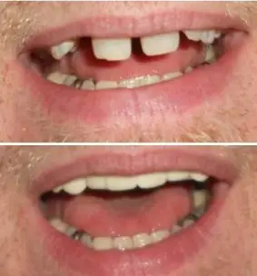 Instant Smile Veneer (Upper Only) photo review