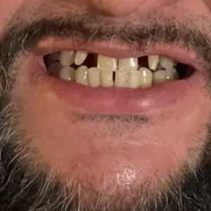 Instant Smile Snap On Veneers (Upper & Lower) Smile Teeth Veneers photo review