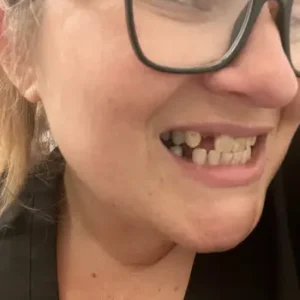 Instant Smile Snap On Veneers (Upper & Lower) Smile Teeth Veneers photo review