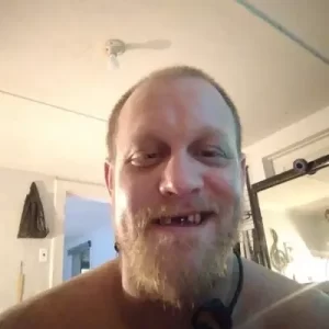 Mike Martin Before - Instant Smile Teeth Veneer Customer