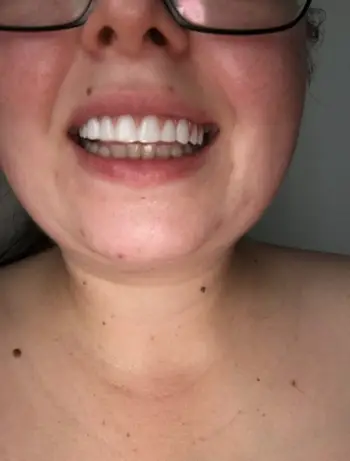 Instant Smile Snap On Veneers (Upper & Lower) Smile Teeth Veneers photo review