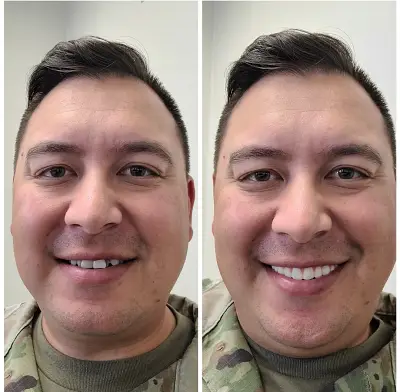 Instant Smile Veneer (Upper Only) photo review