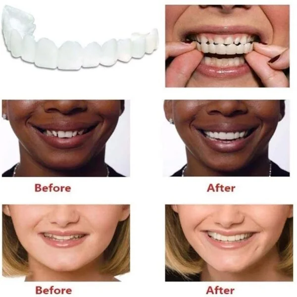 Instant Smile Snap On Veneers (Upper & Lower) Smile Teeth Veneers - Image 4