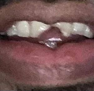 Instant Smile Veneer (Upper Only) photo review