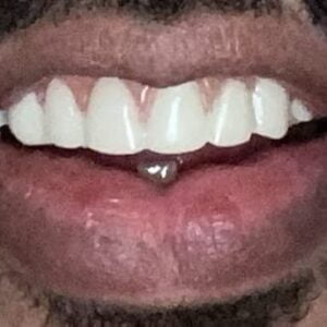 Instant Smile Veneer (Upper Only) photo review