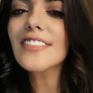 Instant Smile Veneer (Upper Only) photo review