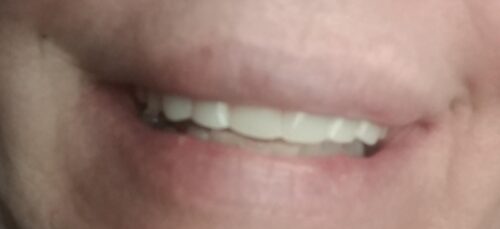 Instant Smile Veneer (Upper Only) photo review