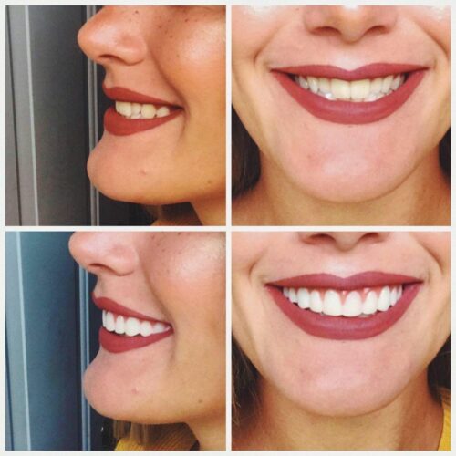 Instant Smile Veneer (Upper Only) photo review