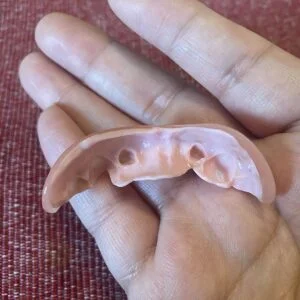 Instant Smile Veneer (Upper Only) photo review