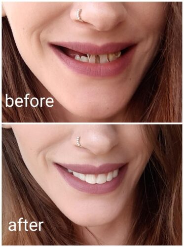Instant Smile Veneer (Upper Only) photo review
