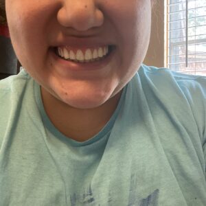 Instant Smile Veneer (Upper Only) photo review