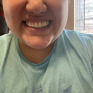 Instant Smile Veneer (Upper Only) photo review