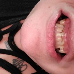 Instant Smile Veneer (Upper Only) photo review