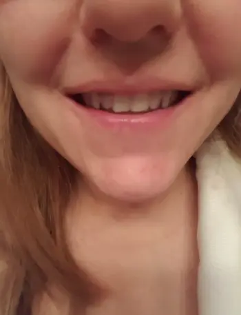 Invisible Teeth Retainer - 3 Stages Straightening Orthodontic Set photo review