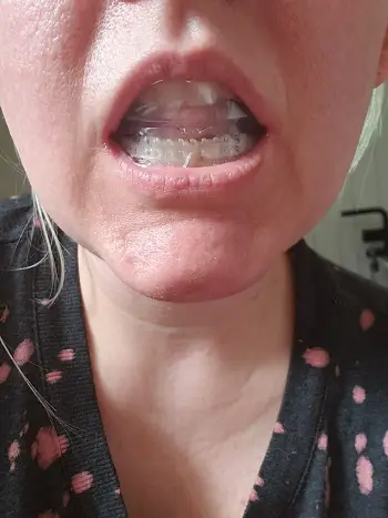 Invisible Teeth Retainer - 3 Stages Straightening Orthodontic Set photo review