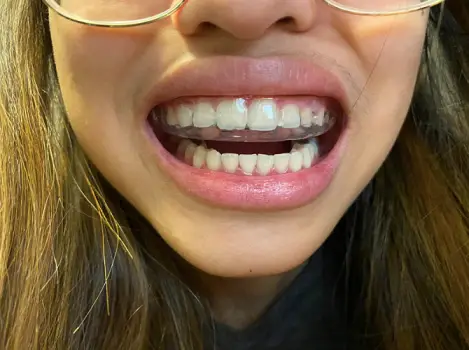 Invisible Teeth Retainer - 3 Stages Straightening Orthodontic Set photo review