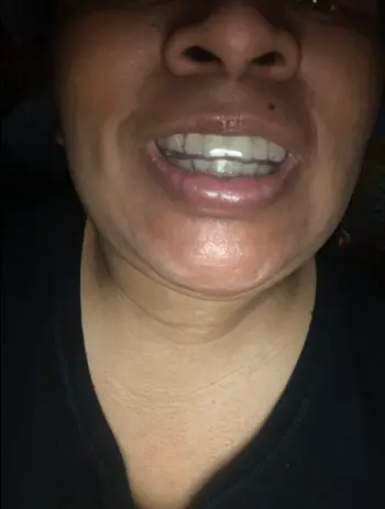 Invisible Teeth Retainer - 3 Stages Straightening Orthodontic Set photo review