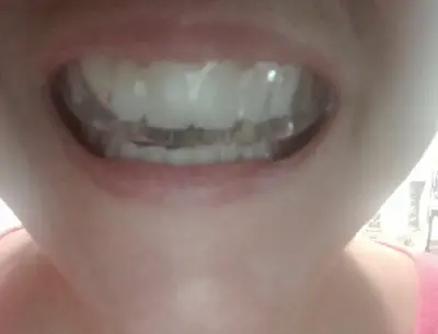 Invisible Teeth Retainer - 3 Stages Straightening Orthodontic Set photo review