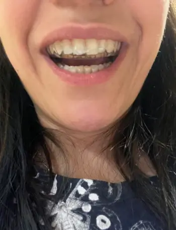 Invisible Teeth Retainer - 3 Stages Straightening Orthodontic Set photo review