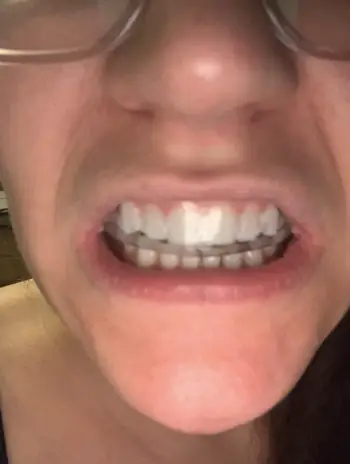 Invisible Teeth Retainer - 3 Stages Straightening Orthodontic Set photo review