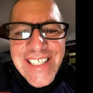 Ron Pughes - Before Instant Smile Veneers (Upper Only) Customer's Review