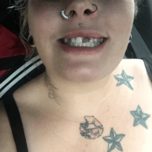 Keely Rae - Instant Smile Teeth Veneers Customer Review Before