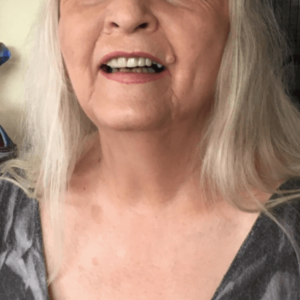 Fred (After) - Instant Smile Customer Review