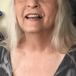 Fred (After) - Instant Smile Customer Review