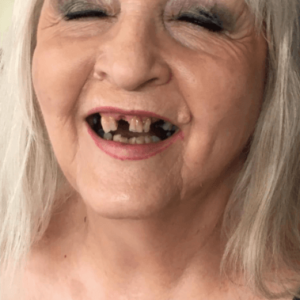 Fred (Before) - Instant Smile Customer Review