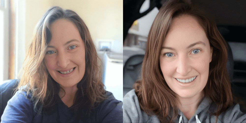 Instant Smile Veneers Customer Before After Image