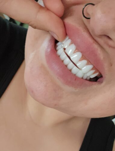 Razzel A. Canada Customer Reviews | Instant Smile Veneer (Upper & Lower)